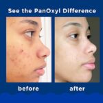 PanOxyl Acne Foaming Face And Body Wash With 10% Benzoyl Peroxide, 156 g - Image 2