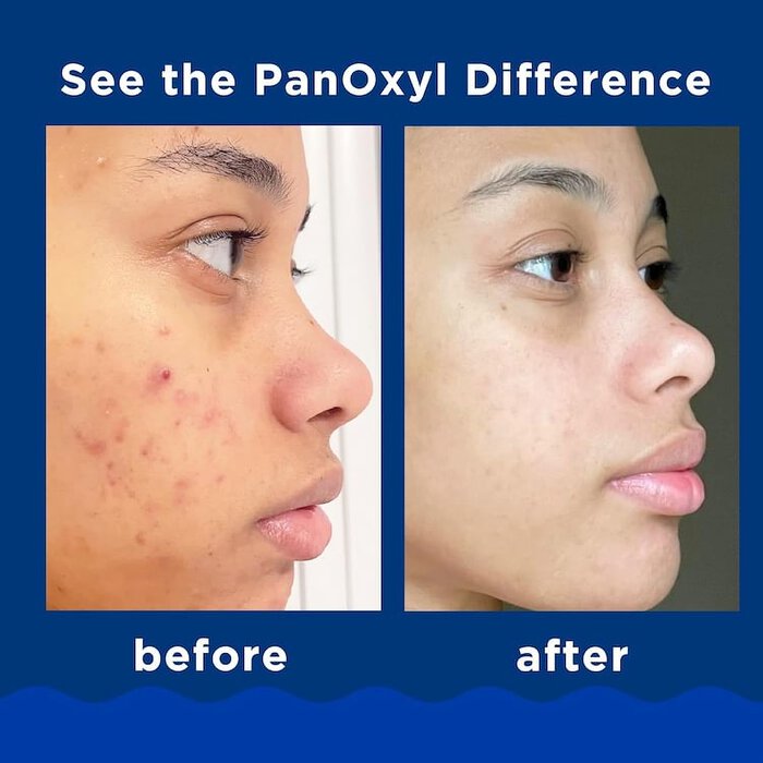 PanOxyl Acne Foaming Face And Body Wash With 10% Benzoyl Peroxide, 156 g - Image 2
